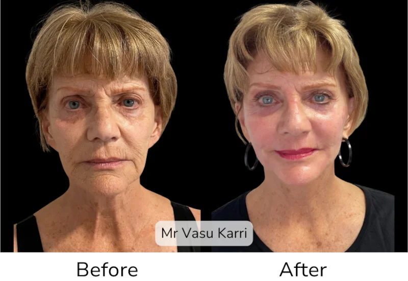 Facelift Patient 2 View 1